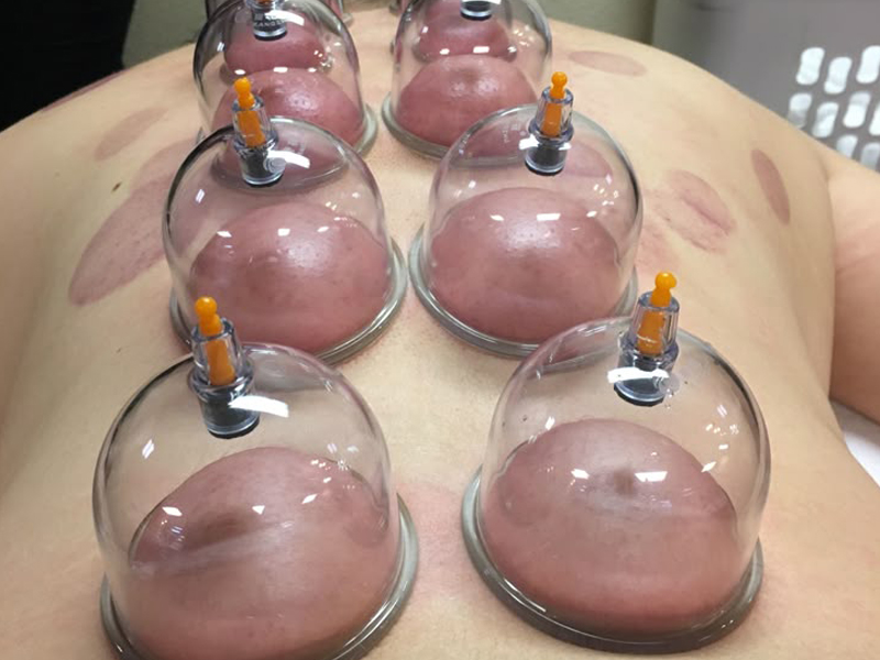 Cupping therapy